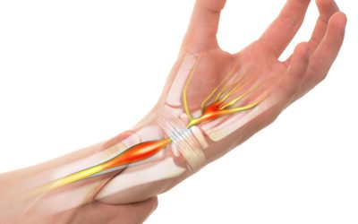 Carpal Tunnel Syndrome