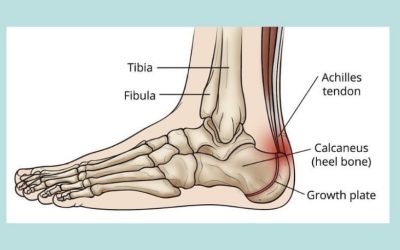 Sever’s Disease