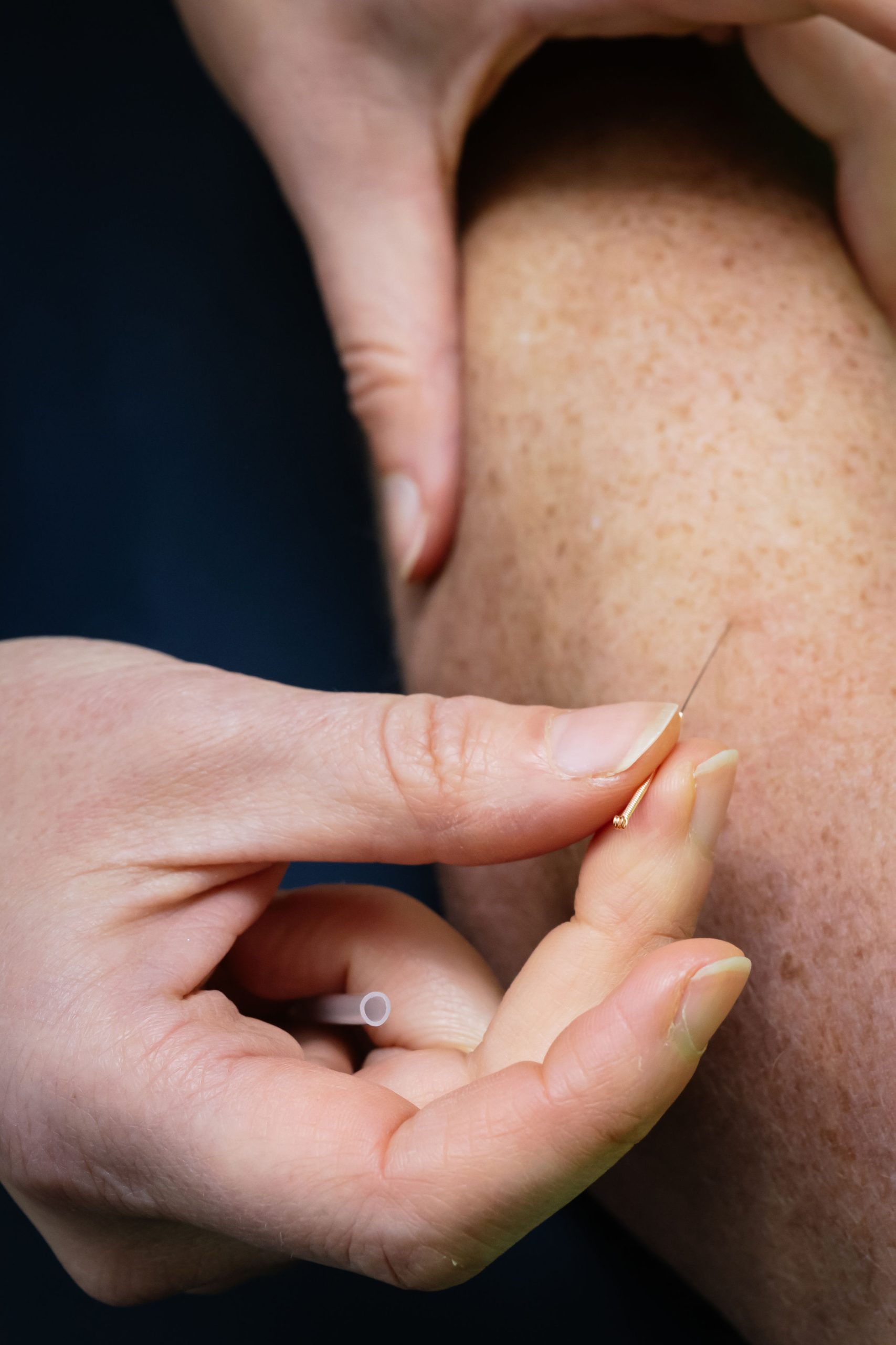 Dry Needling. The what, when and why!