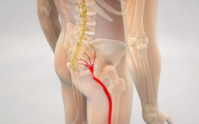 What is sciatica and how can I help manage it?
